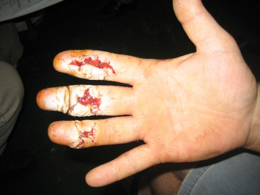 Diver's hand after injury