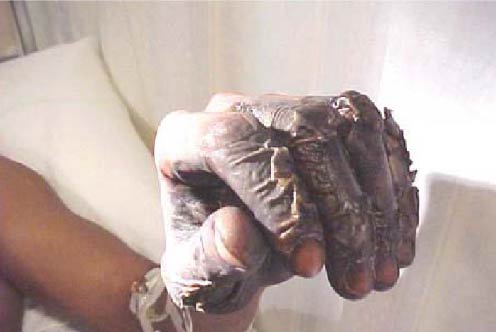 Figure 8 - Welder's burnt hand following oxygen/hydrocarbon fire at leaky hose clamp