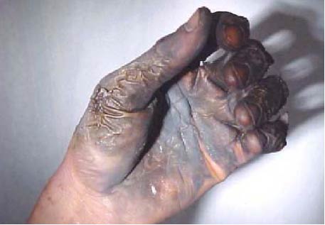 Figure 7 - Welder's burnt hand following oxygen/hydrocarbon fire at leaky hose clamp