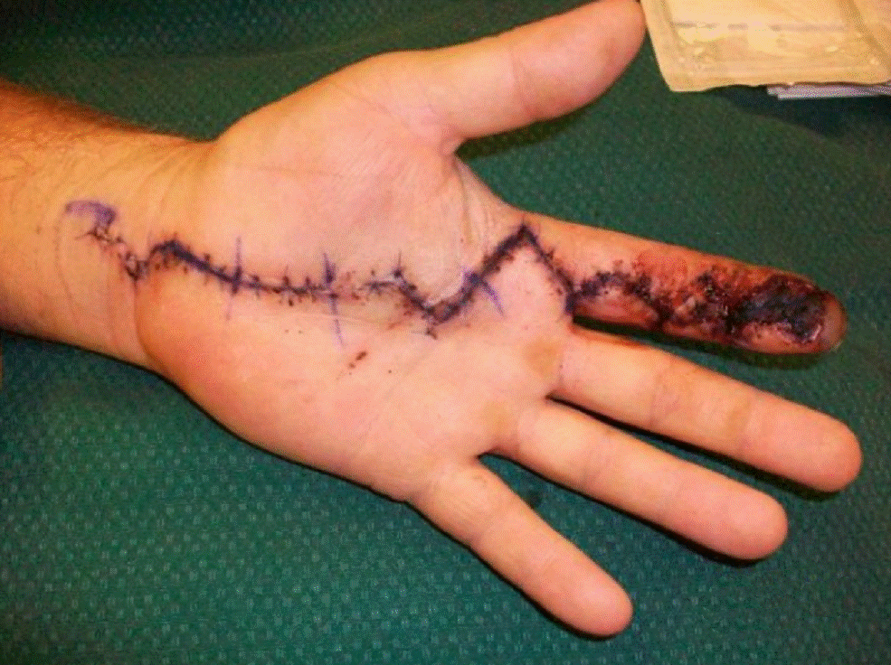Major surgery was required to track and remove the injected hydraulic oil from the person's hand