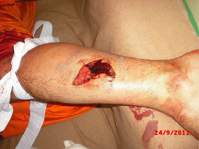 Injured person's shin