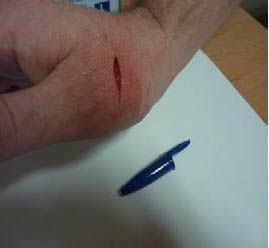 2 cm laceration caused by knife blade